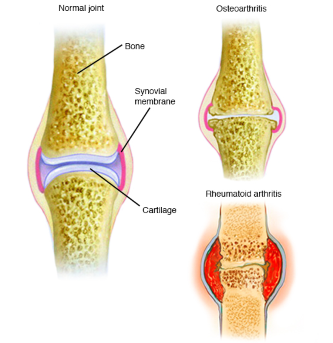 Treat Arthritis